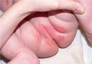 Детский контактный дерматит у ребенка: симптомы, особенности диагностики и способы терапии